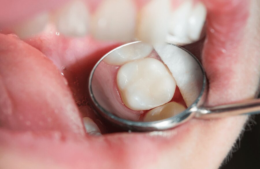 Alternative zu Amalgamfüllungen - Zahnarzt Wetzlar