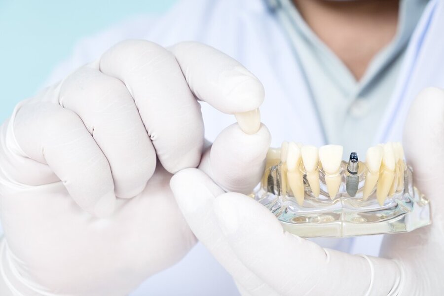 Alternativen zu einer Zahnwurzelbehandlung - Implantate ersetzen die Zahnwurzel - Zahnarzt Wetzlar