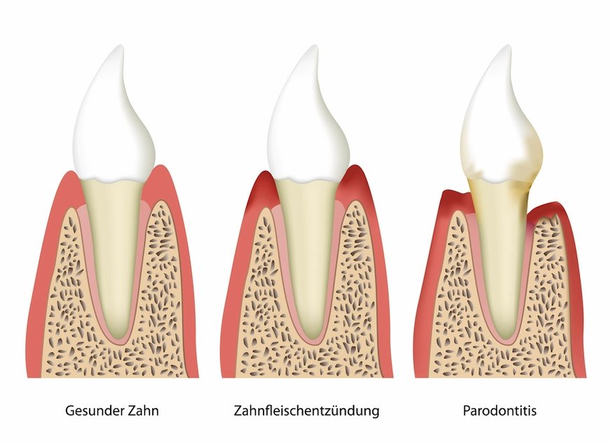 Die Phasen einer Parodontitis - Erkennungsmerkmale einer Parodontose - Zahnarzt Dr. Röder Wetzlar