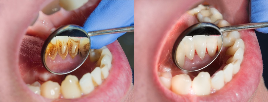 Vorteile einer PZR - Professionelle Zahnreinigung Zahnarztpraxis Dr. Röder in Wetzlar