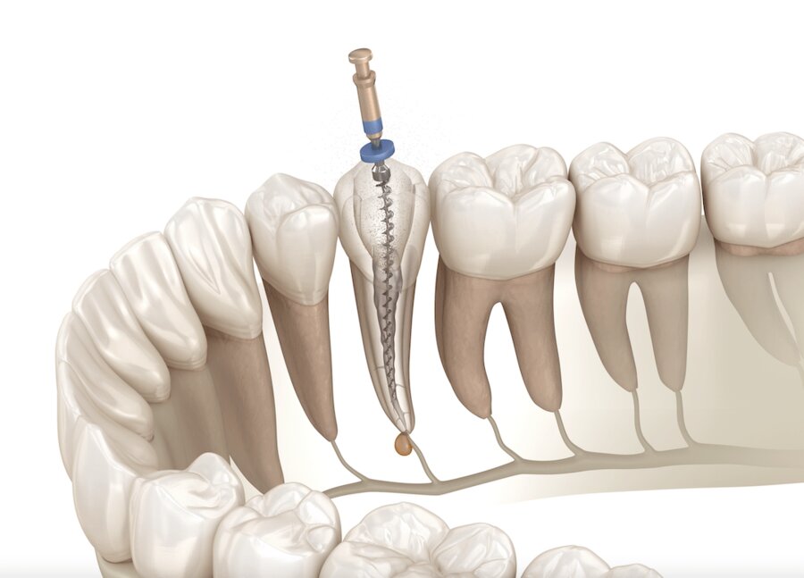 Eine Wurzelkanalbehandlung ist ein endodontischer Eingriff, bei dem das entzündete weiche Pulpagewebe komplett entfernt wird. Zahnarzt Wetzlar