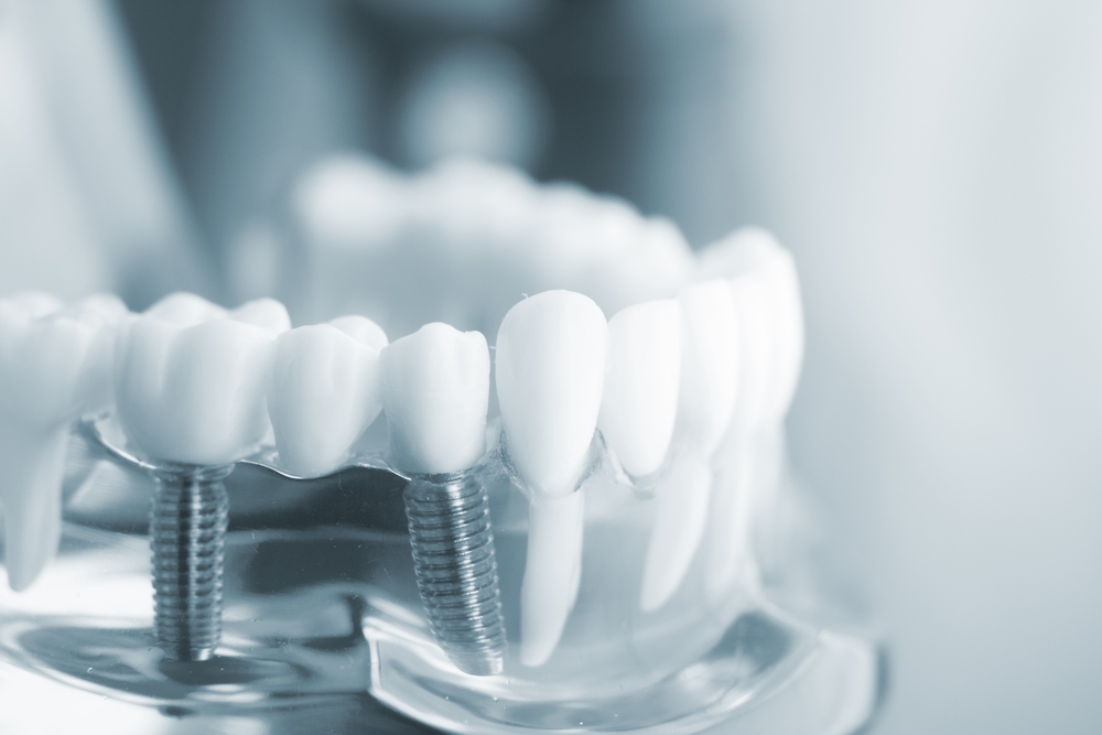 Zahnersatz auf Implantaten - implantatgetragene Zahnbrücken, Kronen oder Zahnprothesen bei Zahnarzt Dr. Röder in Wetzlar