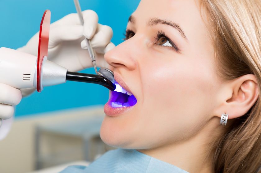 Ablauf einer Zahnfüllung – Füllungstherapie in Wetzlar