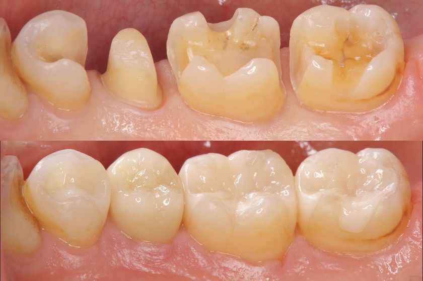 Hochwertige zahnfarbene Zahnfüllungen und Keramik Inlays in Wetzlar bei Zahnarzt Dr. Röder
