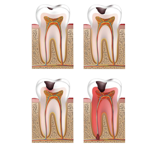 Verlauf einer Karies und deren Symptome - Kariesbehandlung bei Zahnarzt Wetzlar