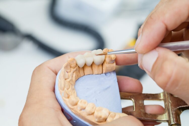 Zahnkronen, Brücken und Inlays aus Keramik in Wetzlar für ästhetischen Zahnersatz