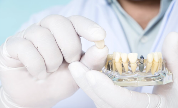 Implantate Wetzlar - Zahnimplantate vom Spezialisten