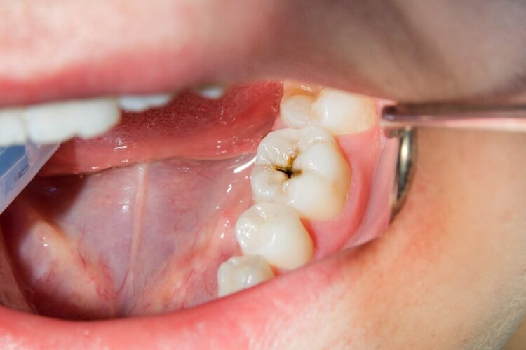 Karies - Die häufigsten Ursachen von Zahnschmerzen - Zahnarzt Wetzlar