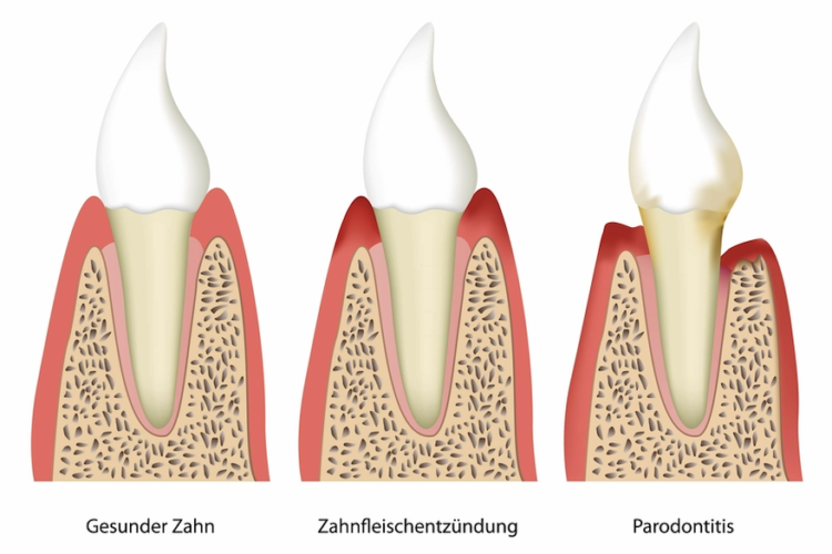 Schmerzen aufgrund einer Zahnfleischentzündung – Parodontose - Zahnarzt Wetzlar