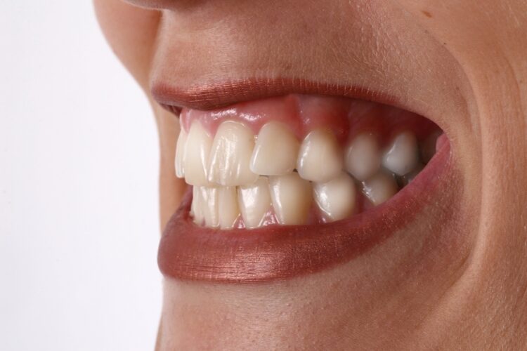 Was ist Zähneknirschen bzw. Bruxismus - Zahnarzt Wetzlar - Zahnzentrum Dr. Röder und Kollegen