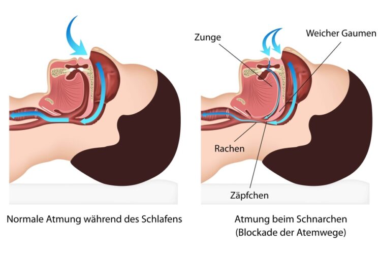 Was verursacht Schnarchen - Zahnarzt Wetzlar Dr. Röder