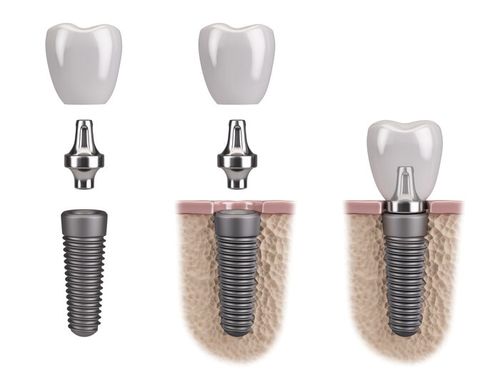Aufbau und Material der Zahnimplantate - Zahnarzt Dr. Röder Wetzlar