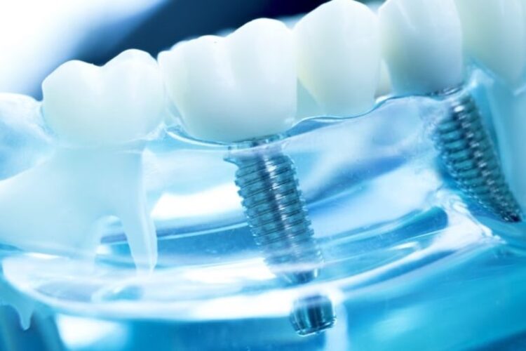 Minimalinvasive Implantologie mit Mini-Implantaten - Implantate bei Zahnarzt Dr. Röder Wetzlar