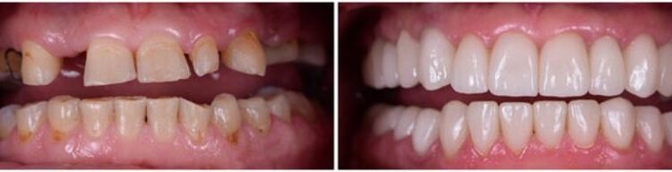 Die Einsatzmöglichkeiten von Zahnimplantaten - Zahnarztpraxis Dr. Röder Wetzlar