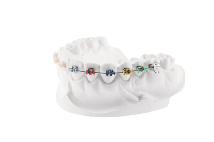Klassische-Bracket-Systeme Kassenstandard Zahnspangen Wetzla