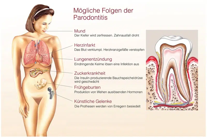 Welche gesundheitlichen Probleme können durch eine schlechte Mundgesundheit verursacht werden? Zahnarzt Wetzlar