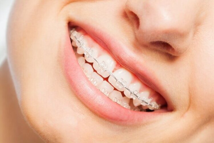 Ist eine Zahnspange für Erwachsene sinnvoll? Zahnarzt Wetzlar - Zahnzentrum Dr. Roeder und Kollegen