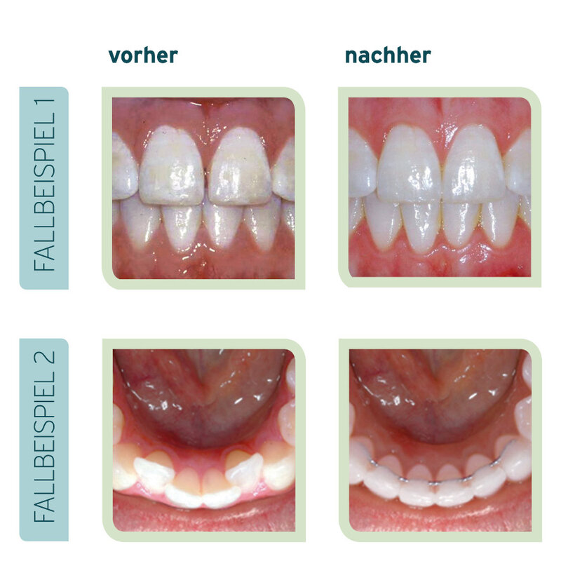 Vor und nach einer Zahnfehlstellungskorrektur mit Clear Aligner - Wie lange dauert die Behandlung mit dem Clear Aligner?