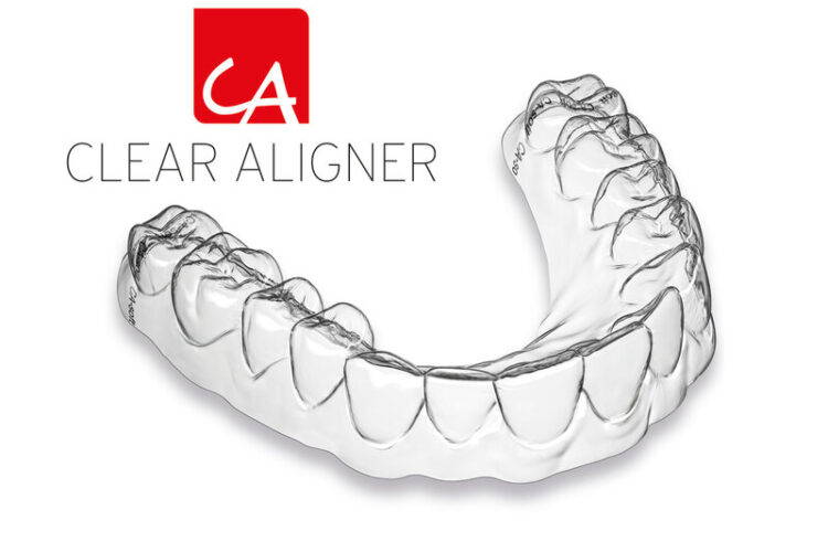 Was-ist-eine-Clear-Aligner®-Zahnschiene-Zahnarzt-Wetzlar-Zahnzentrum-Dr.-Roeder-und-Kollegen