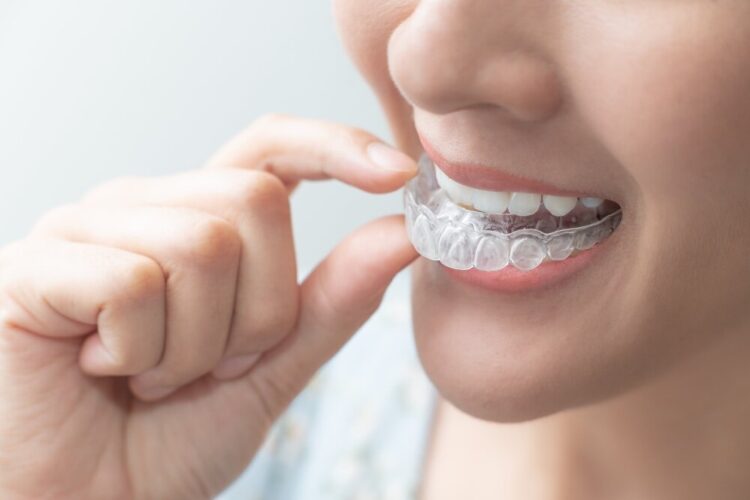 Was sind die typischen Zahnspangen für Erwachsene? Clear Aligner - unsichtbare Zahnspange bei Kieferorthopädie Wetzlar