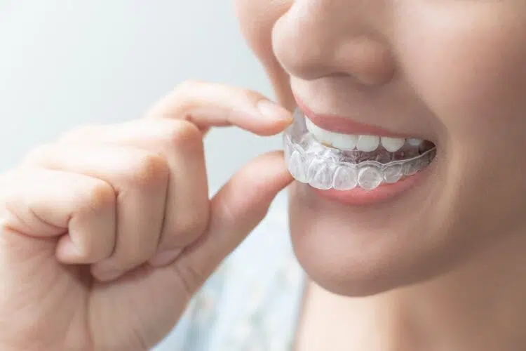 Was sind die typischen Zahnspangen für Erwachsene? Clear Aligner - unsichtbare Zahnspange bei Kieferorthopädie Wetzlar