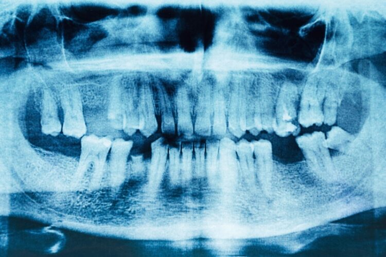 Kieferknochenverlust an der Zahnlücke - Warum fehlende Zähne ersetzt werden müssen - Zahnarzt Wetzlar