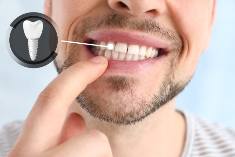Zahnimplantate: Was sind die Vorteile und Nachteile - Zahnarzt Wetzlar
